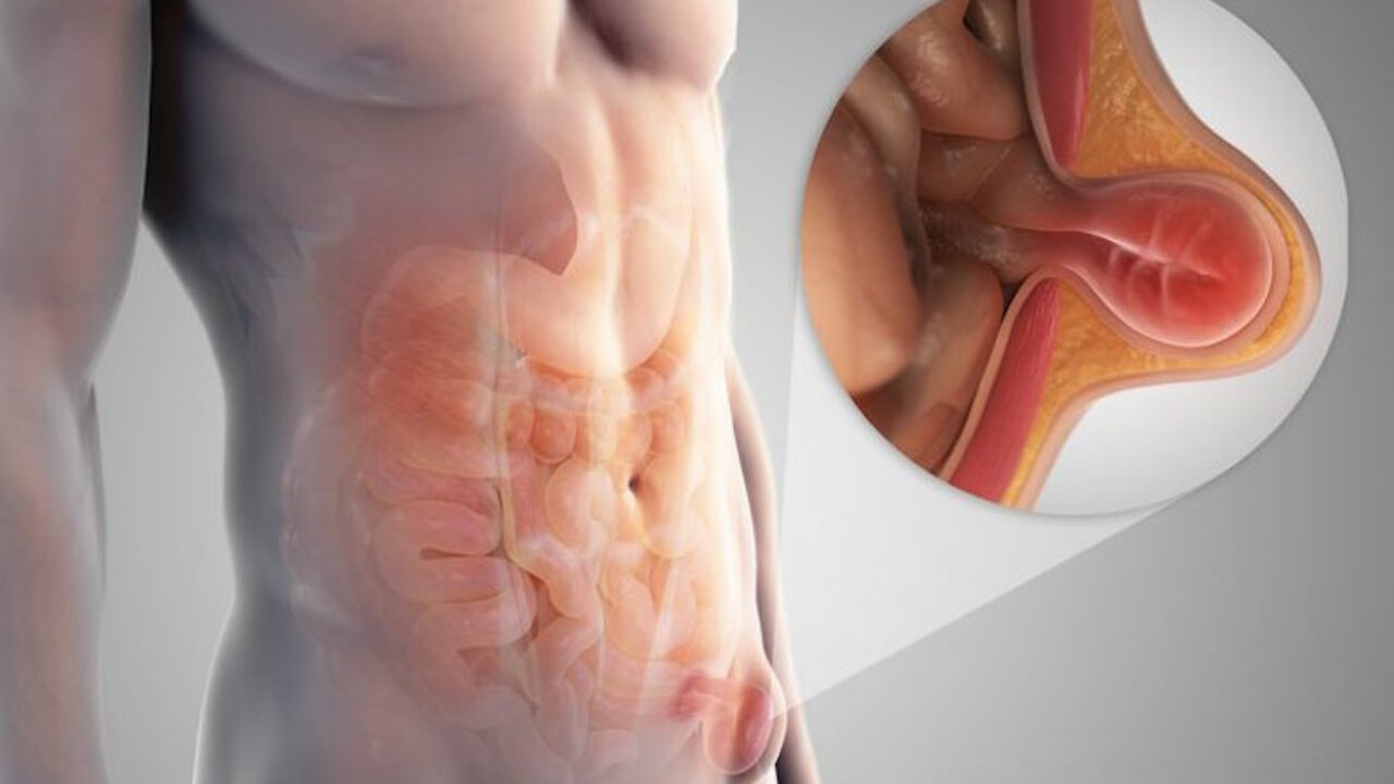 Inguinal hernia